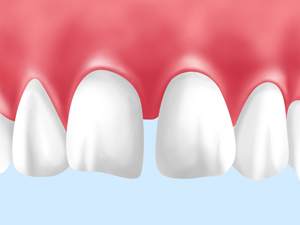 空隙歯列（くうげきしれつ）：すきっ歯